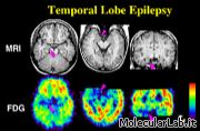 Epilessia sul cervello