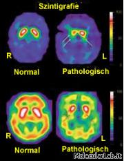 Scintillografia che mostra cervello Parkinsoniano