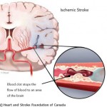 stroke_isc_web