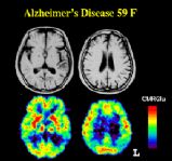 Effetti malattia Alzheimer