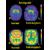 Neuroni da staminali contro il Parkinson