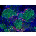 Staminali convertite in cellule beta del pancreas Staminali convertite in cellule beta del pancreas