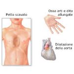 Effetti della Sindrome di Marfan