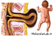 Spina Bifida