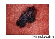 Melanoma