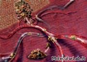 Diffusione del cancro in metastasi