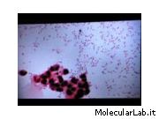 Meningite batterica