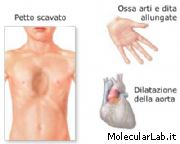 Effetti della Sindrome di Marfan