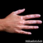 Vitiligine su una mano