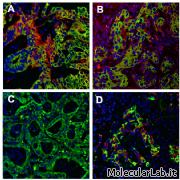 Colangiocarcinoma, tumore delle vie biliari