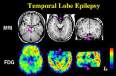 Epilessia sul cervello