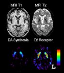 Analisi PET su cervello Parkinsoniano