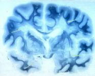 Cervello in paziente affetto da Sclerosi Multipla