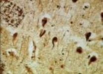 Placche nel cervello per Alzheimer