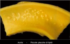 Placche di colesterolo nella parete interna aorta