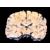 La molecola che incattivisce il tumore al cervello